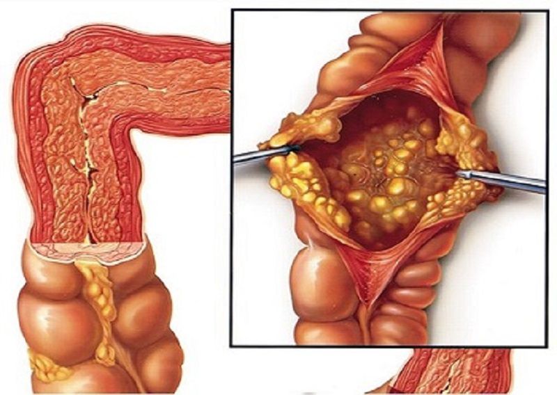 Bệnh nhân thoát “án tử” ung thư đại tràng nhờ thăm khám tại Bệnh viện Đa khoa MEDLATEC 1