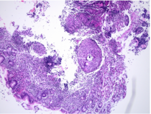 Bệnh viện Đa khoa MEDLATEC chẩn đoán và điều trị trường hợp mắc lao dạ dày rất hiếm gặp 15